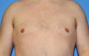 Gynecomastia Before and After Pictures Plano, TX