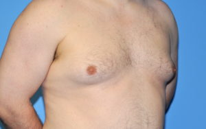 Gynecomastia Before and After Pictures Plano, TX