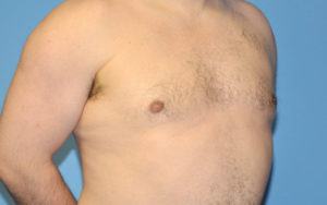 Gynecomastia Before and After Pictures Plano, TX