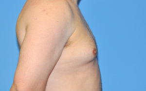 Gynecomastia Before and After Pictures Plano, TX