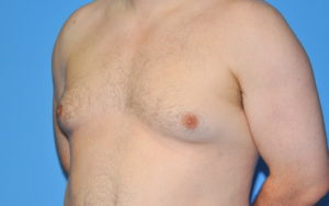 Gynecomastia Before and After Pictures Plano, TX