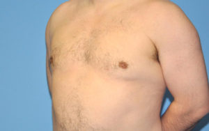 Gynecomastia Before and After Pictures Plano, TX