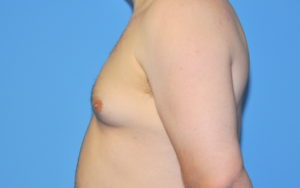 Gynecomastia Before and After Pictures Plano, TX