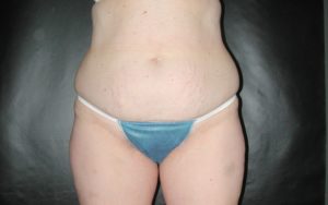 Liposuction Before and After Pictures Plano, TX