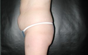 Liposuction Before and After Pictures Plano, TX