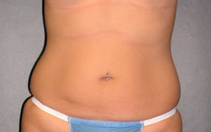 Liposuction Before and After Pictures Plano, TX