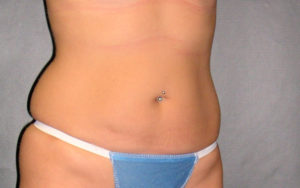 Liposuction Before and After Pictures Plano, TX