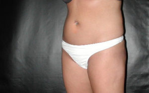 Liposuction Before and After Pictures Plano, TX