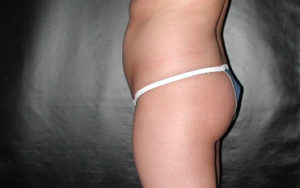 Liposuction Before and After Pictures Plano, TX