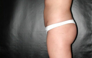 Liposuction Before and After Pictures Plano, TX