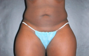 Liposuction Before and After Pictures Plano, TX