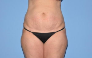 Liposuction Before and After Pictures Plano, TX