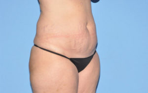 Liposuction Before and After Pictures Plano, TX
