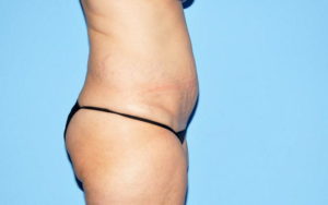 Liposuction Before and After Pictures Plano, TX