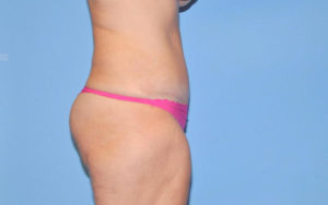 Liposuction Before and After Pictures Plano, TX