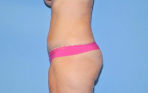 Liposuction Before and After Pictures Plano, TX