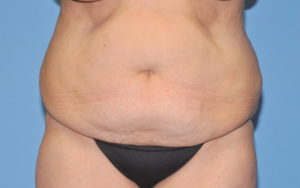 Liposuction Before and After Pictures Plano, TX