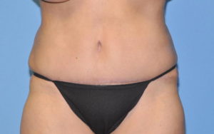 Liposuction Before and After Pictures Plano, TX