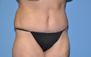 Liposuction Before and After Pictures Plano, TX