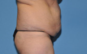 Liposuction Before and After Pictures Plano, TX