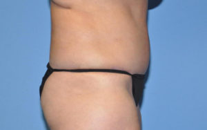 Liposuction Before and After Pictures Plano, TX