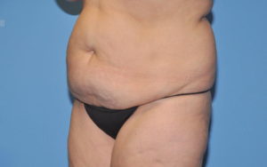 Liposuction Before and After Pictures Plano, TX