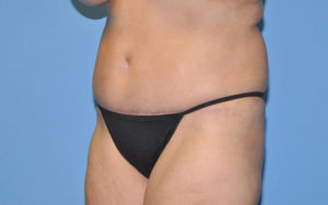 Liposuction Before and After Pictures Plano, TX