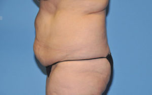 Liposuction Before and After Pictures Plano, TX