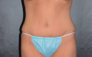 Tummy Tuck Before and After Pictures Plano, TX