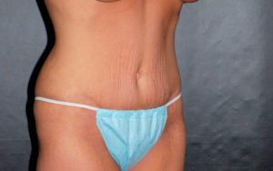 Tummy Tuck Before and After Pictures Plano, TX