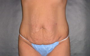 Tummy Tuck Before and After Pictures Plano, TX