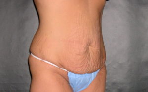 Tummy Tuck Before and After Pictures Plano, TX