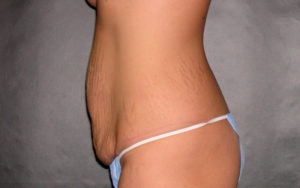 Tummy Tuck Before and After Pictures Plano, TX