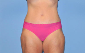 Tummy Tuck Before and After Pictures Plano, TX