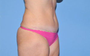 Tummy Tuck Before and After Pictures Plano, TX