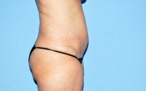 Tummy Tuck Before and After Pictures Plano, TX