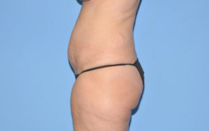 Tummy Tuck Before and After Pictures Plano, TX