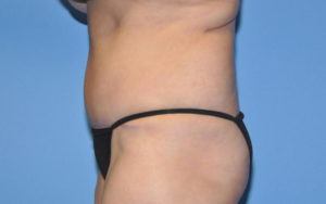 Tummy Tuck Before and After Pictures Plano, TX