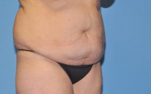 Tummy Tuck Before and After Pictures Plano, TX