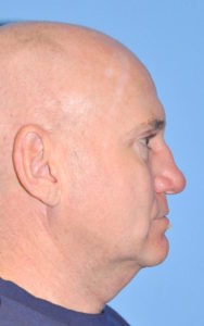 Facelift Before and After Pictures Plano, TX