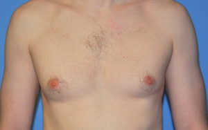 Gynecomastia Before and After Pictures Plano, TX