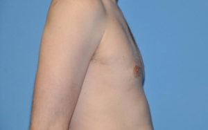 Gynecomastia Before and After Pictures Plano, TX