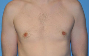 Gynecomastia Before and After Pictures Plano, TX