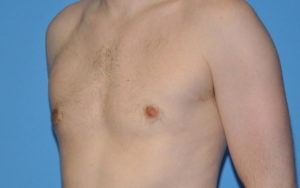 Gynecomastia Before and After Pictures Plano, TX