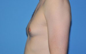 Gynecomastia Before and After Pictures Plano, TX