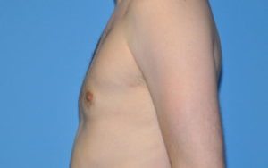 Gynecomastia Before and After Pictures Plano, TX