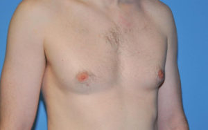 Gynecomastia Before and After Pictures Plano, TX