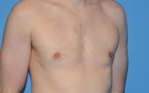 Gynecomastia Before and After Pictures Plano, TX