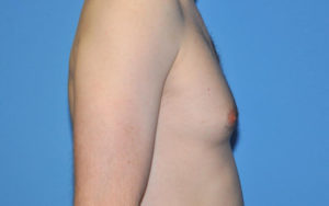 Gynecomastia Before and After Pictures Plano, TX