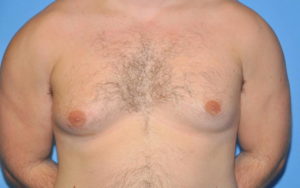 Gynecomastia Before and After Pictures Plano, TX
